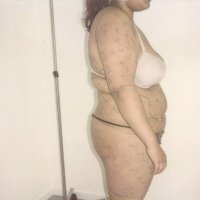 Voor behandeling - zijaanzicht