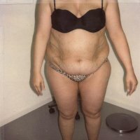 Voor behandeling - vooraanzicht