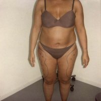 Na behandeling - vooraanzicht