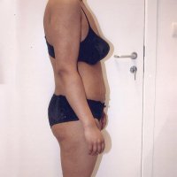 Na behandeling - zijaanzicht