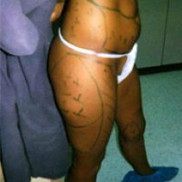 Voor behandeling - zijaanzicht