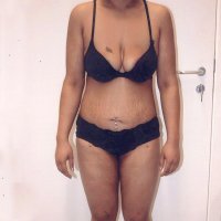 Na behandeling - vooraanzicht