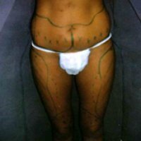 Voor behandeling - vooraanzicht